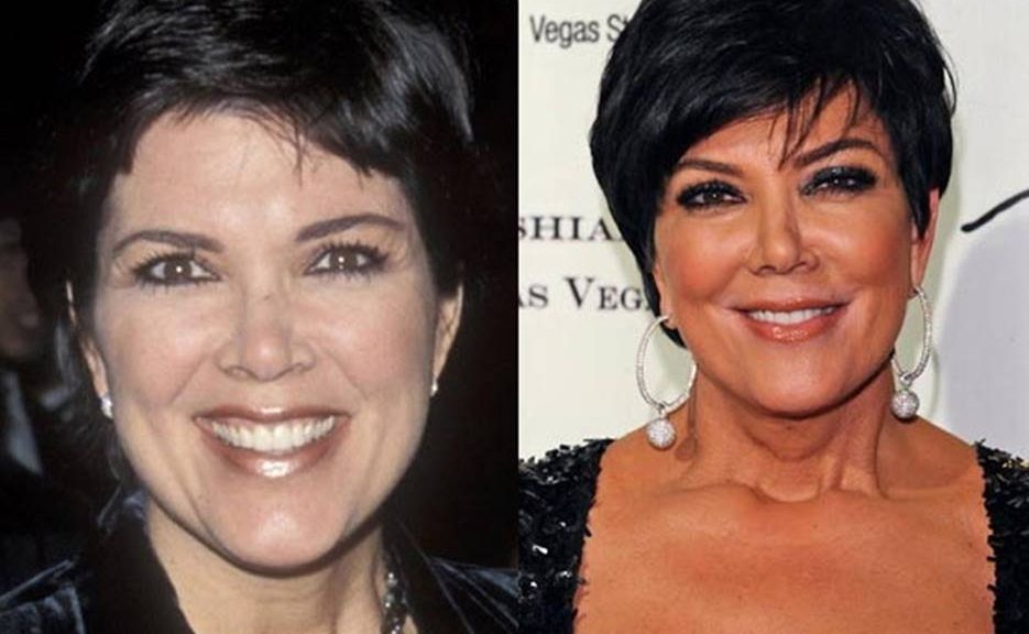 Kris Jenner Before and After